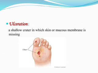 Ulceration :
a shallow crater in which skin or mucous membrane is
missing
 
