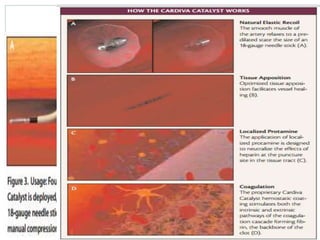 Closure devices | PPTX