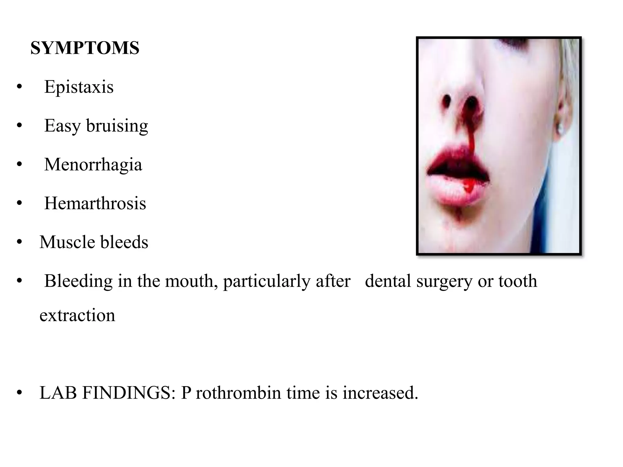 SYMPTOMS
• Epistaxis
• Easy bruising
• Menorrhagia
• Hemarthrosis
• Muscle bleeds
• Bleeding in the mouth, particularly after dental surgery or tooth
extraction
• LAB FINDINGS: P rothrombin time is increased.
 