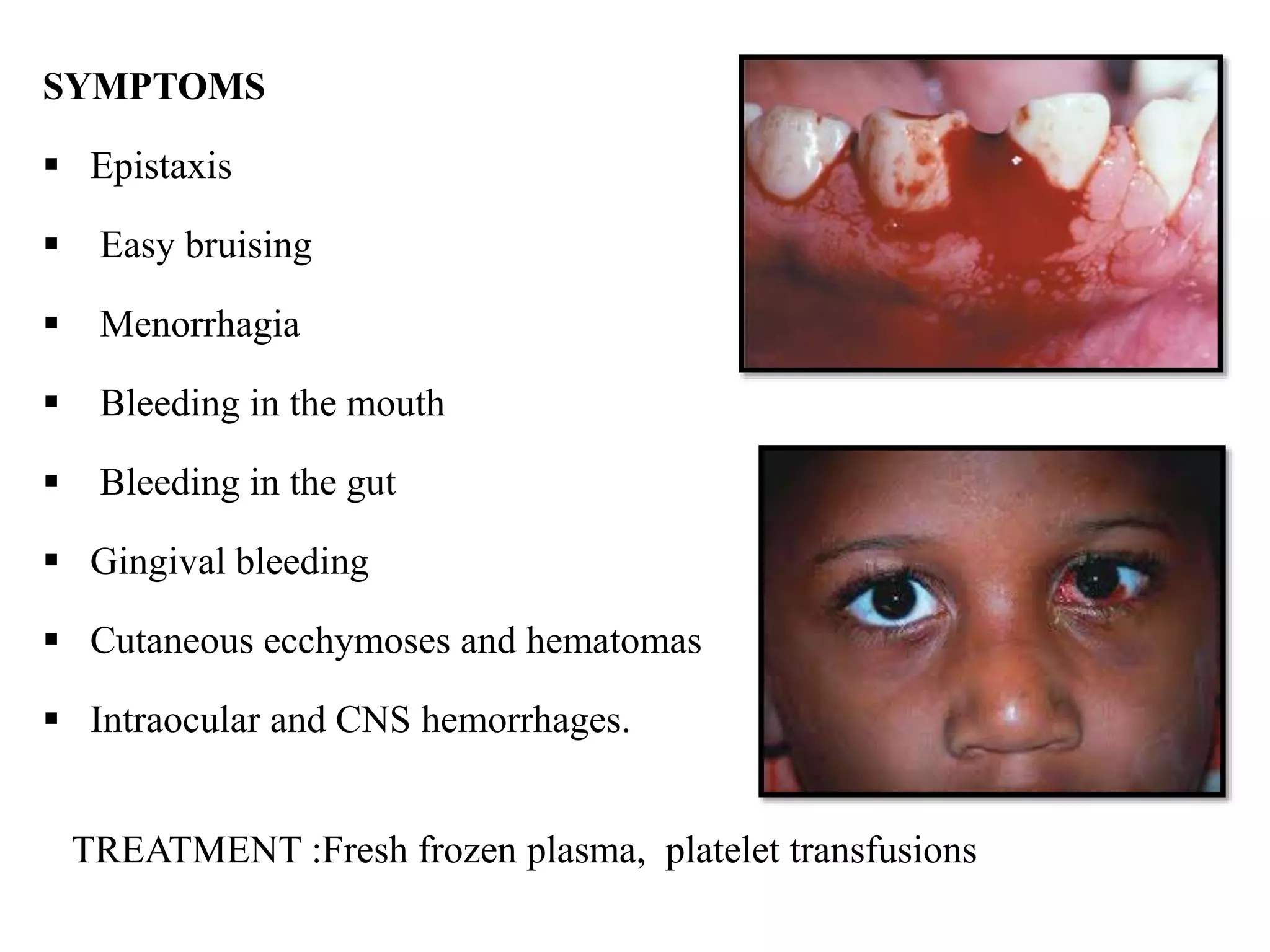 SYMPTOMS
 Epistaxis
 Easy bruising
 Menorrhagia
 Bleeding in the mouth
 Bleeding in the gut
 Gingival bleeding
 Cutaneous ecchymoses and hematomas
 Intraocular and CNS hemorrhages.
TREATMENT :Fresh frozen plasma, platelet transfusions
 