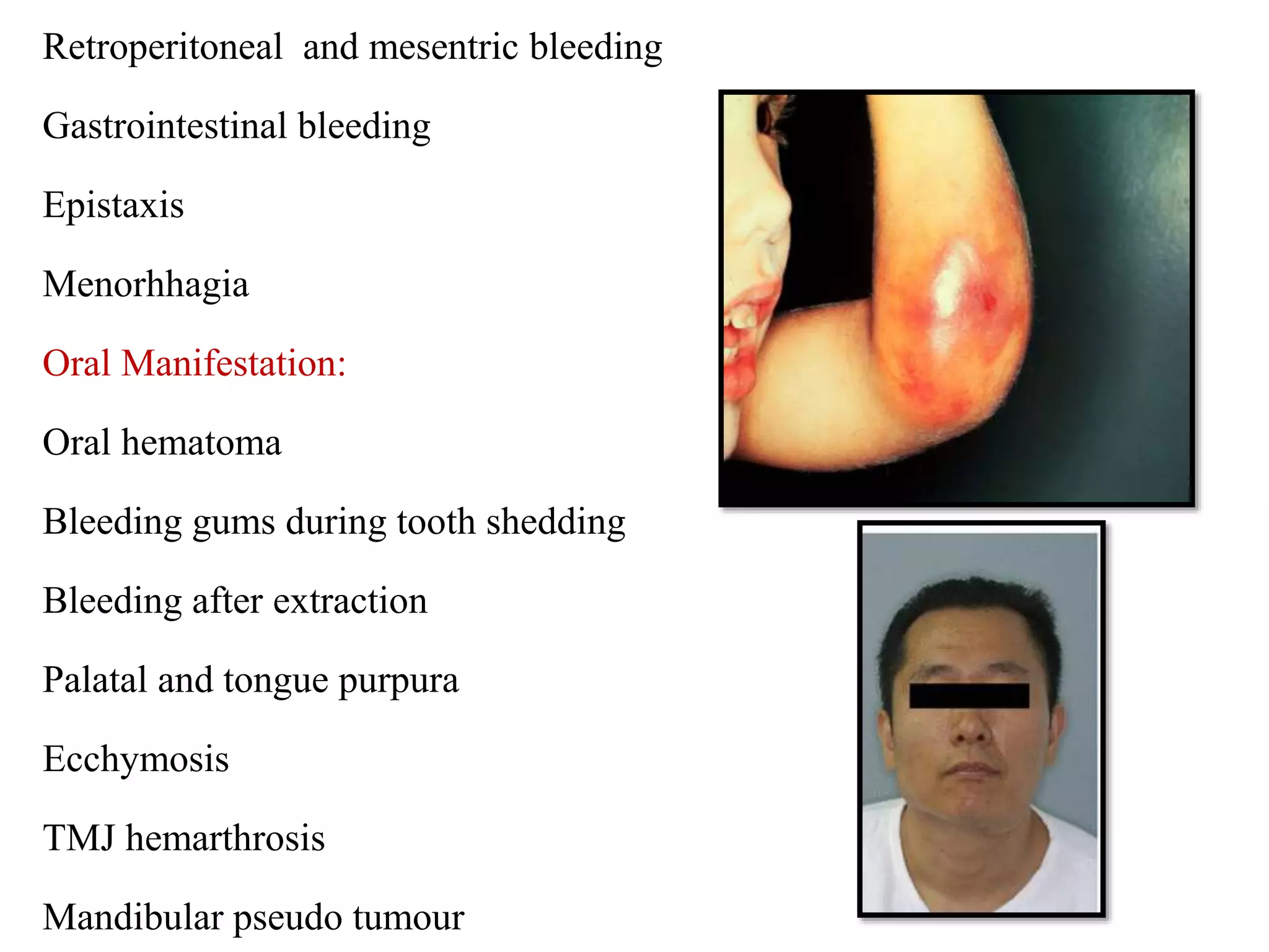 Retroperitoneal and mesentric bleeding
Gastrointestinal bleeding
Epistaxis
Menorhhagia
Oral Manifestation:
Oral hematoma
Bleeding gums during tooth shedding
Bleeding after extraction
Palatal and tongue purpura
Ecchymosis
TMJ hemarthrosis
Mandibular pseudo tumour
 