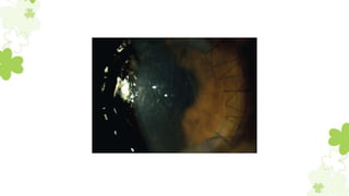 Postoperative Complication of DALK | PPTX
