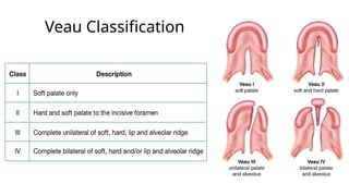 Veau Classfication Cleft lip and palate: Brief overview.pptx
