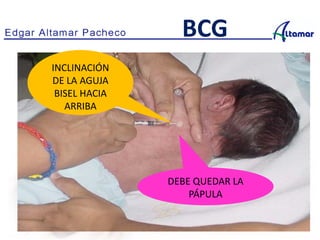 DEBE QUEDAR LA
PÁPULA
BCG
INCLINACIÓN
DE LA AGUJA
BISEL HACIA
ARRIBA
 