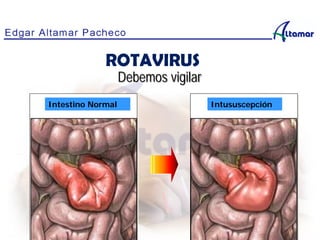 Debemos vigilar
Intestino Normal Intususcepción
ROTAVIRUS
 