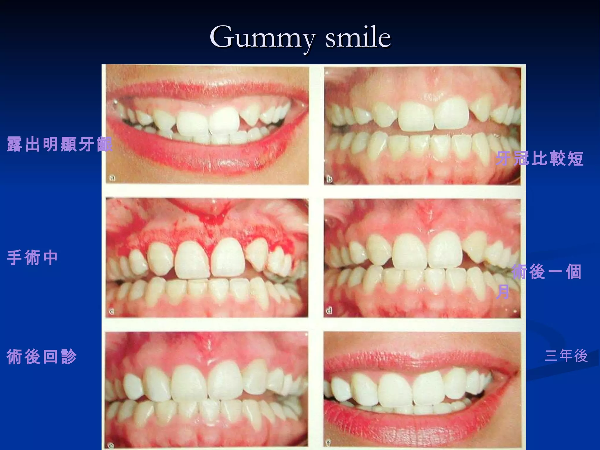 Gummy smile 露出明顯牙齦 手術中 術後回診 牙冠比較短 術後一個月 三年後 