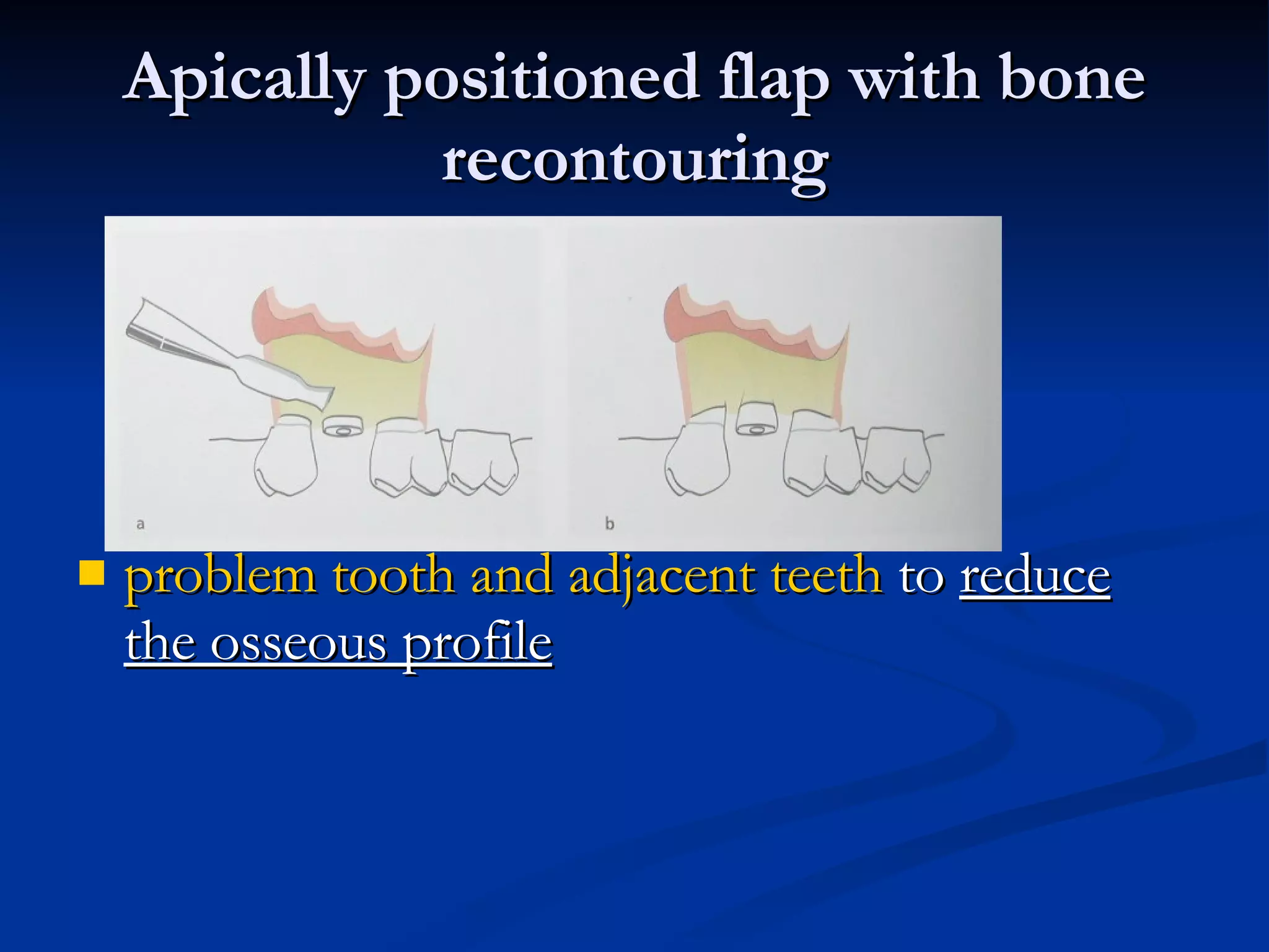 Apically positioned flap with bone recontouring problem tooth and adjacent teeth  to  reduce the osseous profile 