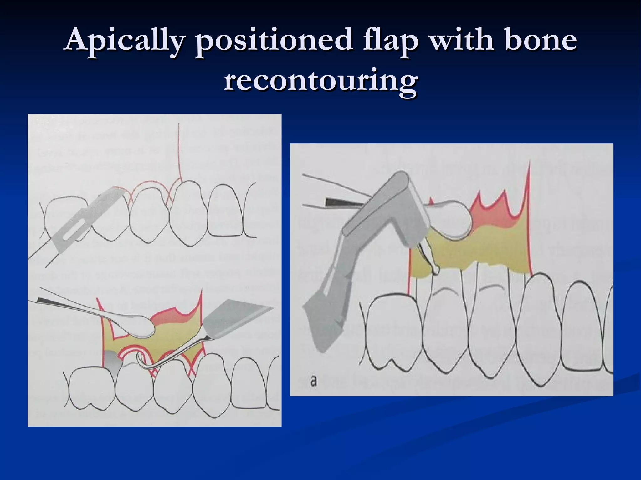 Apically positioned flap with bone recontouring 