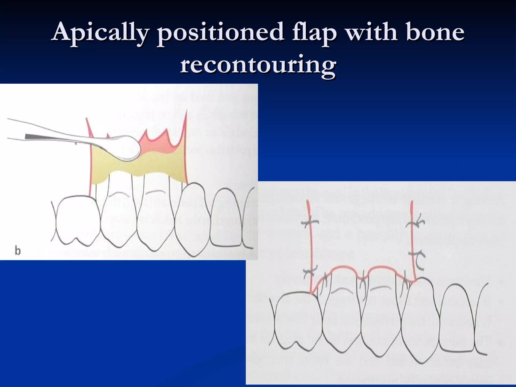 Apically positioned flap with bone recontouring 