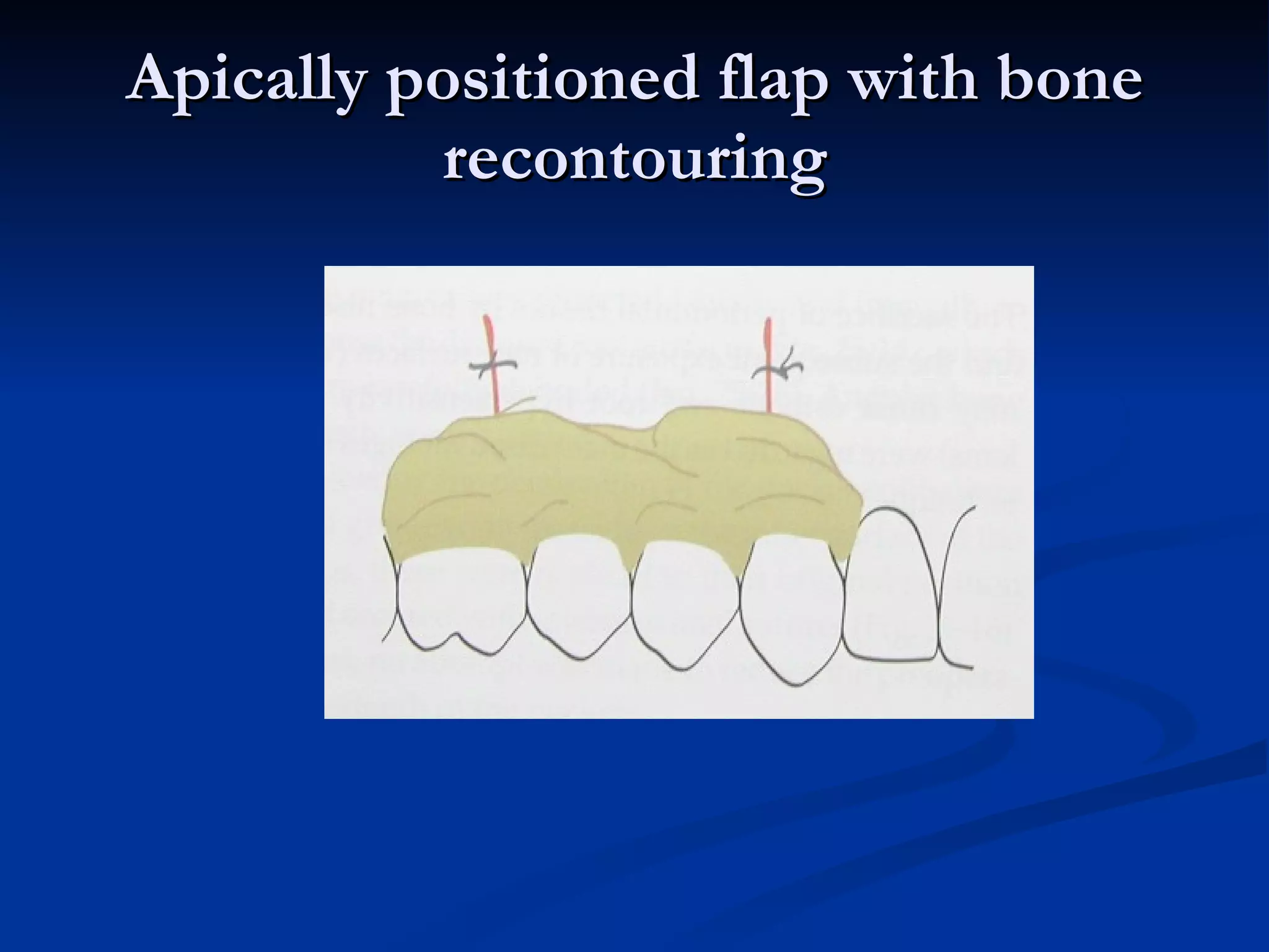 Apically positioned flap with bone recontouring 