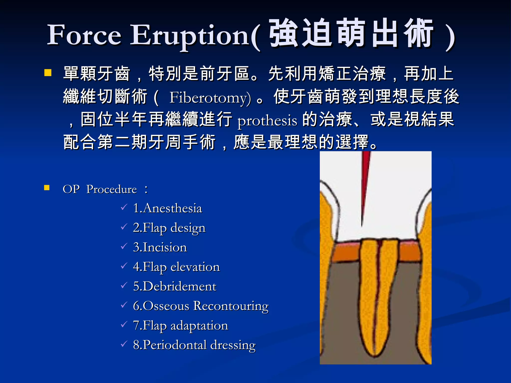 Force Eruption( 強迫萌出術 ) 單顆牙齒，特別是前牙區。先利用矯正治療，再加上纖維切斷術（ Fiberotomy) 。使牙齒萌發到理想長度後，固位半年再繼續進行 prothesis 的治療、或是視結果配合第二期牙周手術，應是最理想的選擇。 OP  Procedure ： 1.Anesthesia 2.Flap design 3.Incision 4.Flap elevation 5.Debridement 6.Osseous Recontouring 7.Flap adaptation 8.Periodontal dressing 