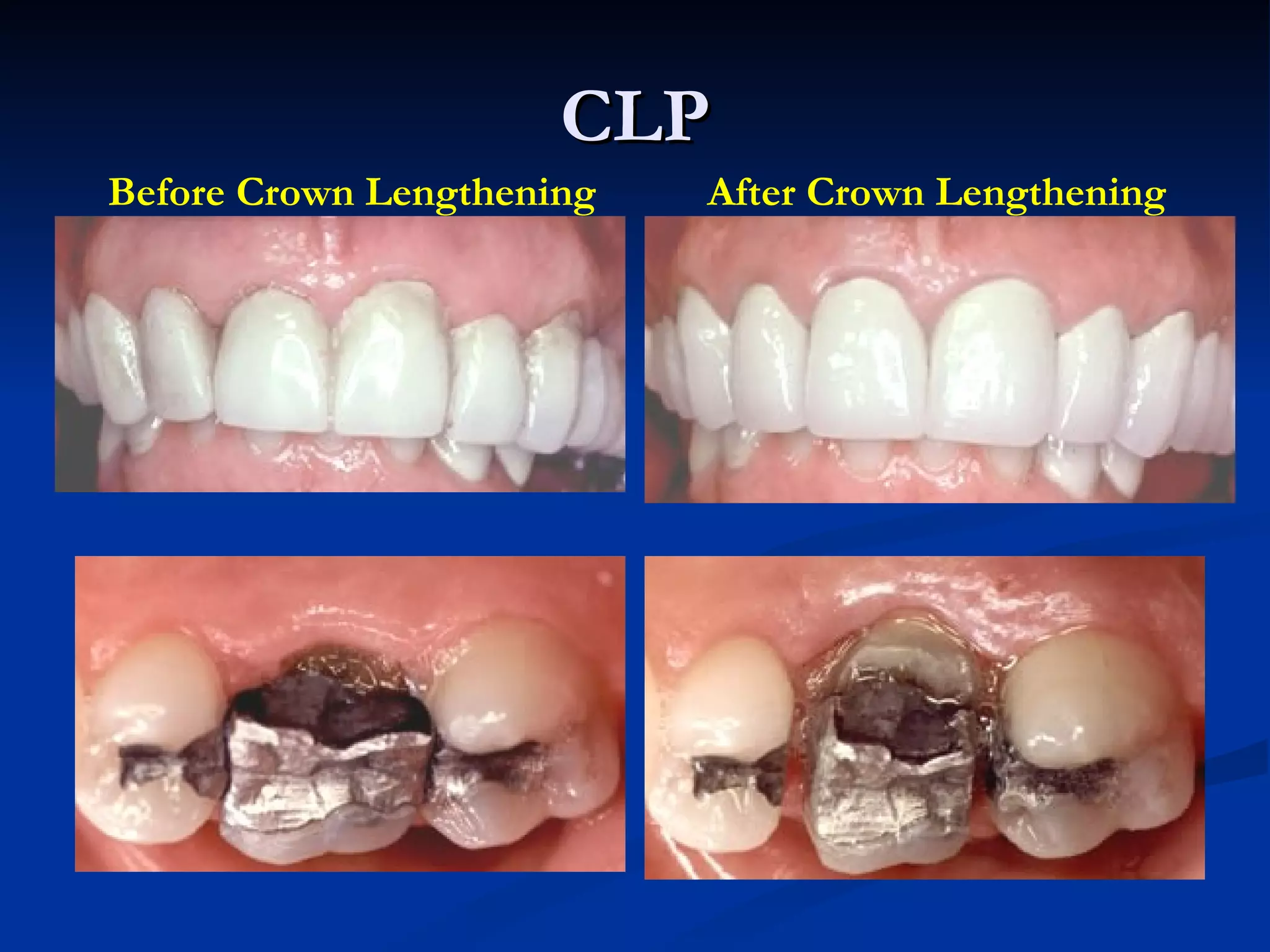 CLP Before Crown Lengthening After Crown Lengthening 