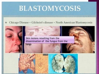 Skin lesions resulting from the
dissemination of the fungus from the
lungs
 