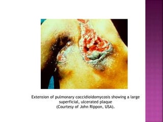 Extension of pulmonary coccidioidomycosis showing a large
superficial, ulcerated plaque
(Courtesy of John Rippon, USA).
 