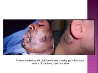 Chronic cutaneous coccidioidomycosis showing granulomatous
lesions of the face, neck and chin
 