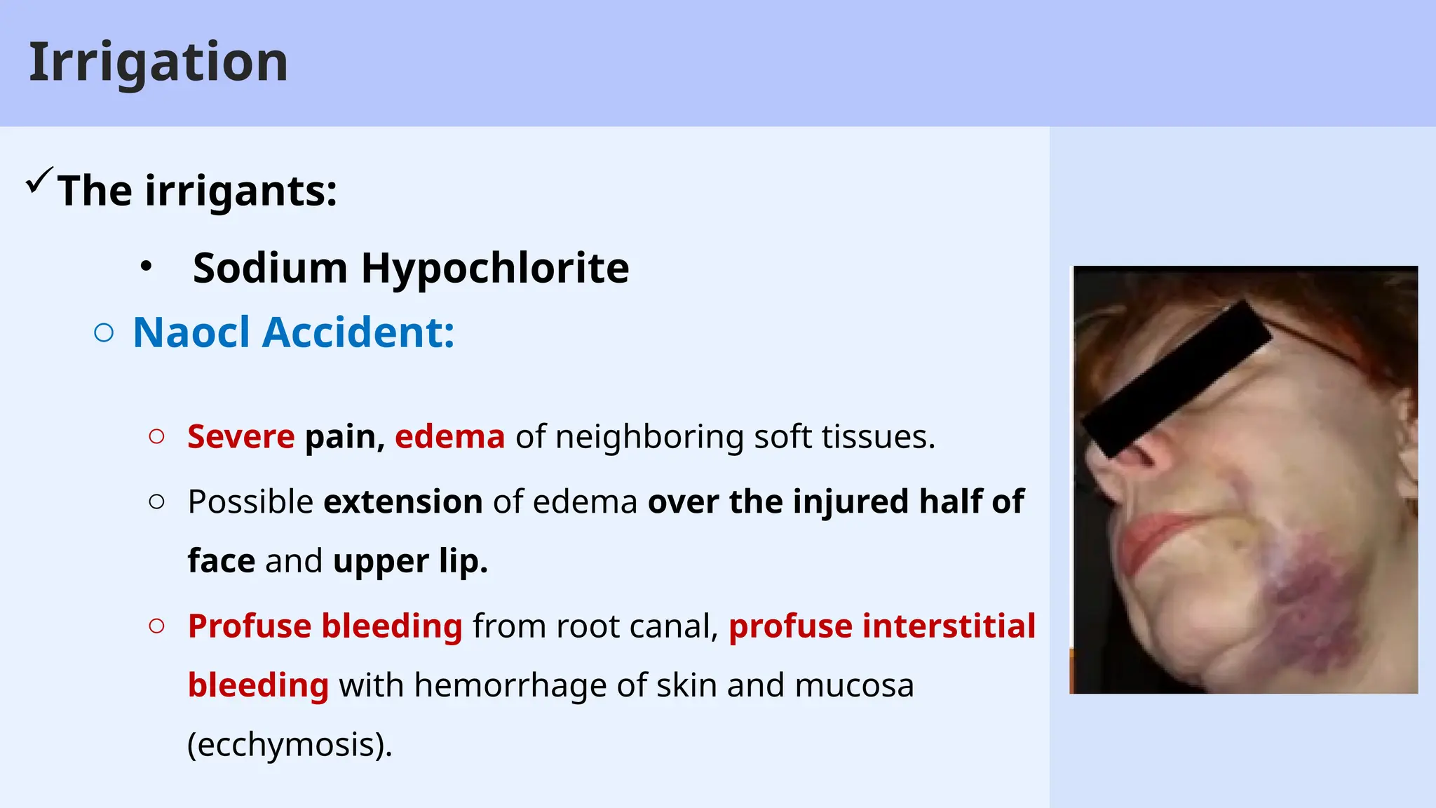 32
Irrigation
The irrigants:
o Naocl Accident:
• Sodium Hypochlorite
o Severe pain, edema of neighboring soft tissues.
o Possible extension of edema over the injured half of
face and upper lip.
o Profuse bleeding from root canal, profuse interstitial
bleeding with hemorrhage of skin and mucosa
(ecchymosis).
 