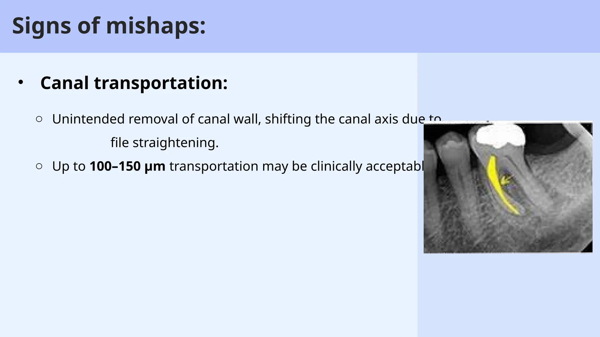 67
Signs of mishaps:
• Canal transportation:
o Unintended removal of canal wall, shifting the canal axis due to
file straightening.
o Up to 100–150 µm transportation may be clinically acceptable.
 