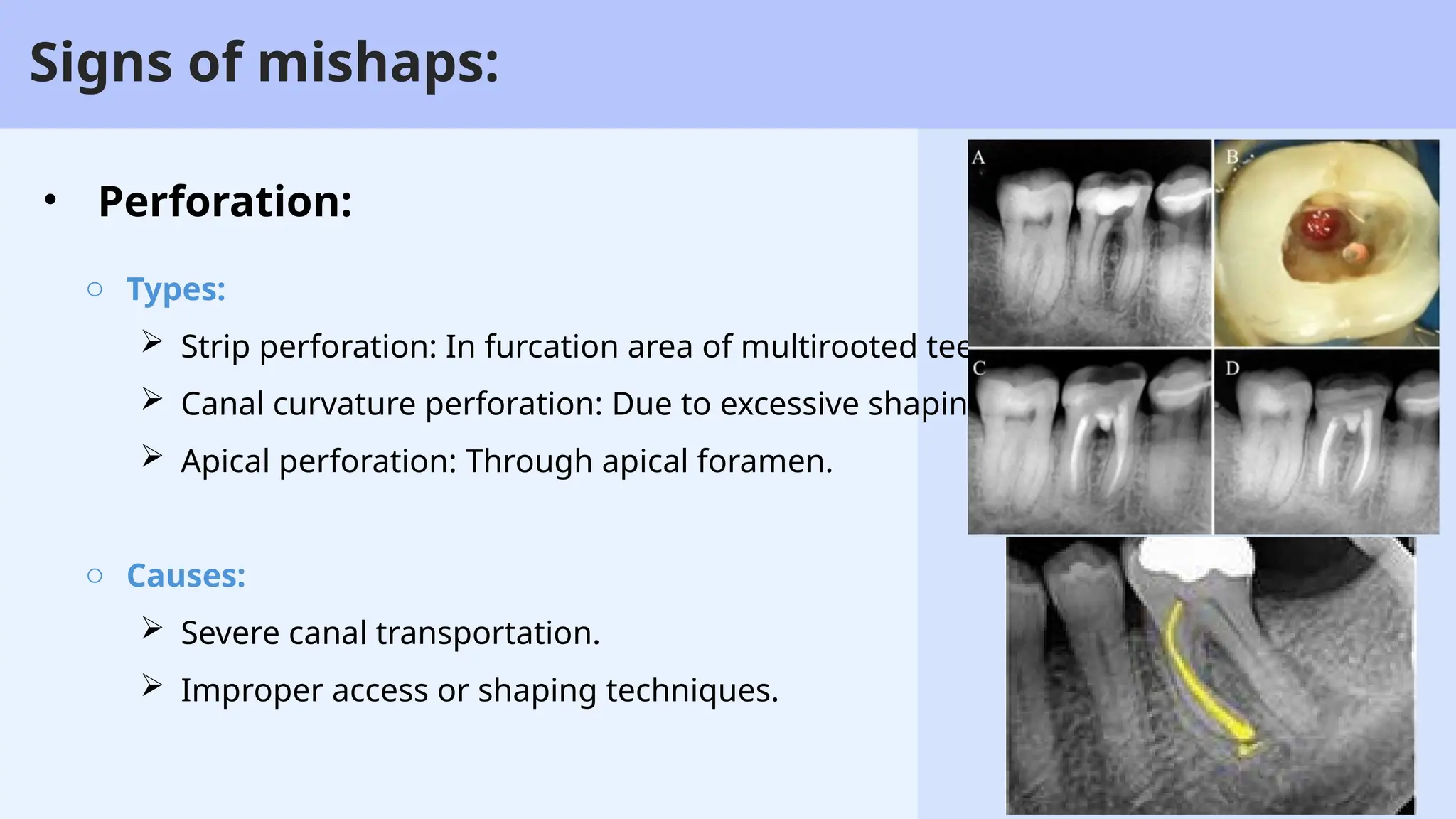68
Signs of mishaps:
• Perforation:
o Types:
 Strip perforation: In furcation area of multirooted teeth.
 Canal curvature perforation: Due to excessive shaping.
 Apical perforation: Through apical foramen.
o Causes:
 Severe canal transportation.
 Improper access or shaping techniques.
 