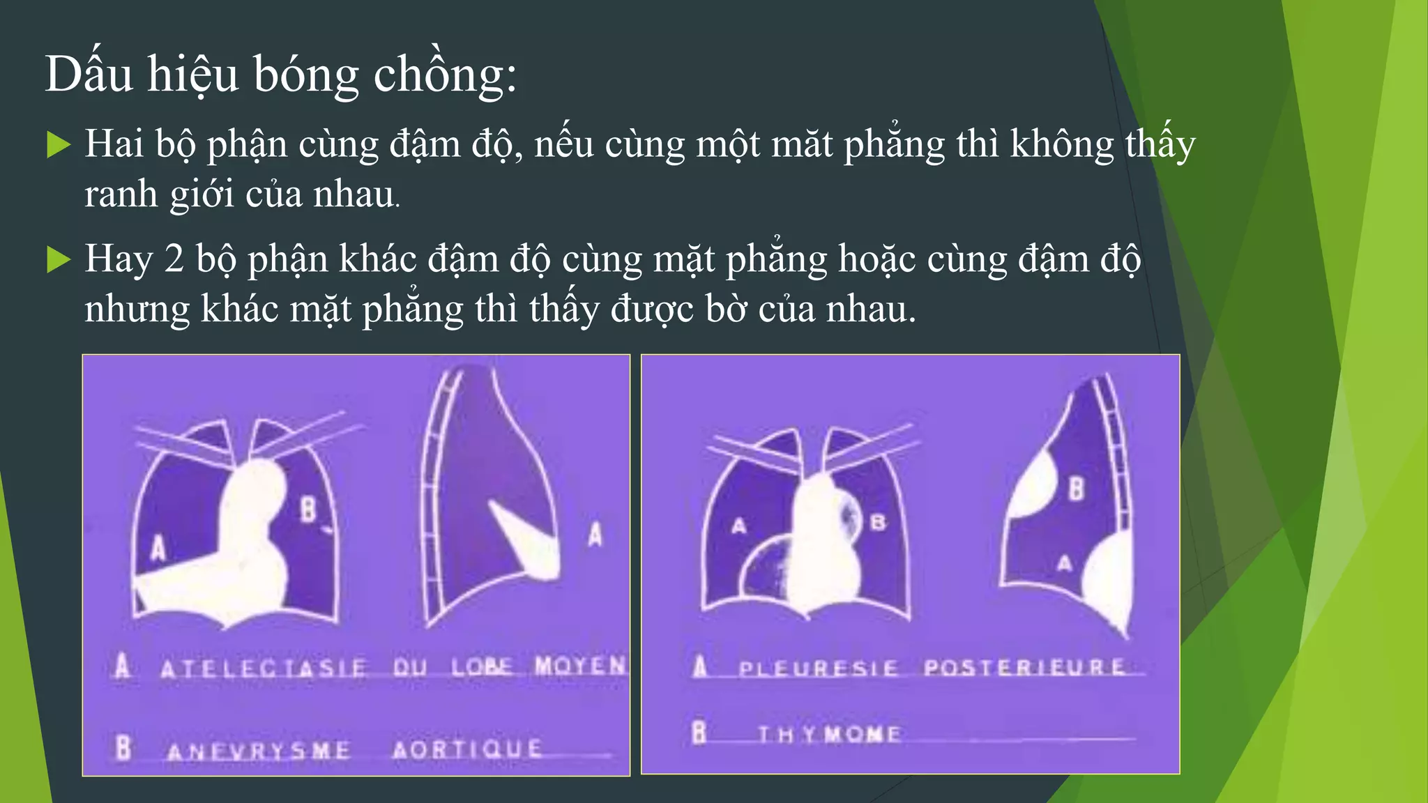 Dấu hiệu bóng chồng:
 Hai bộ phận cùng đậm độ, nếu cùng một măt phẳng thì không thấy
ranh giới của nhau.
 Hay 2 bộ phận khác đậm độ cùng mặt phẳng hoặc cùng đậm độ
nhưng khác mặt phẳng thì thấy được bờ của nhau.
 