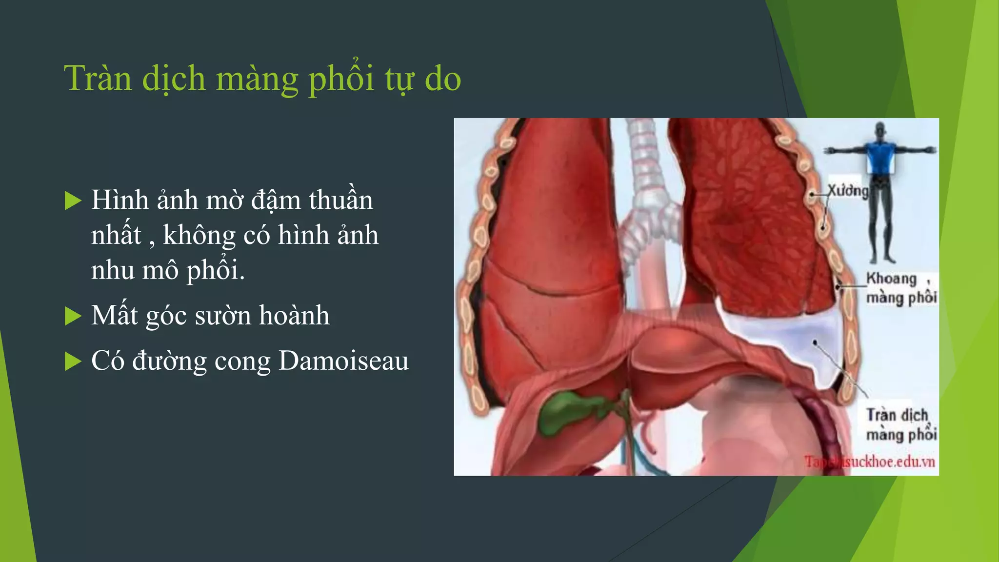 Tràn dịch màng phổi tự do
 Hình ảnh mờ đậm thuần
nhất , không có hình ảnh
nhu mô phổi.
 Mất góc sườn hoành
 Có đường cong Damoiseau
 