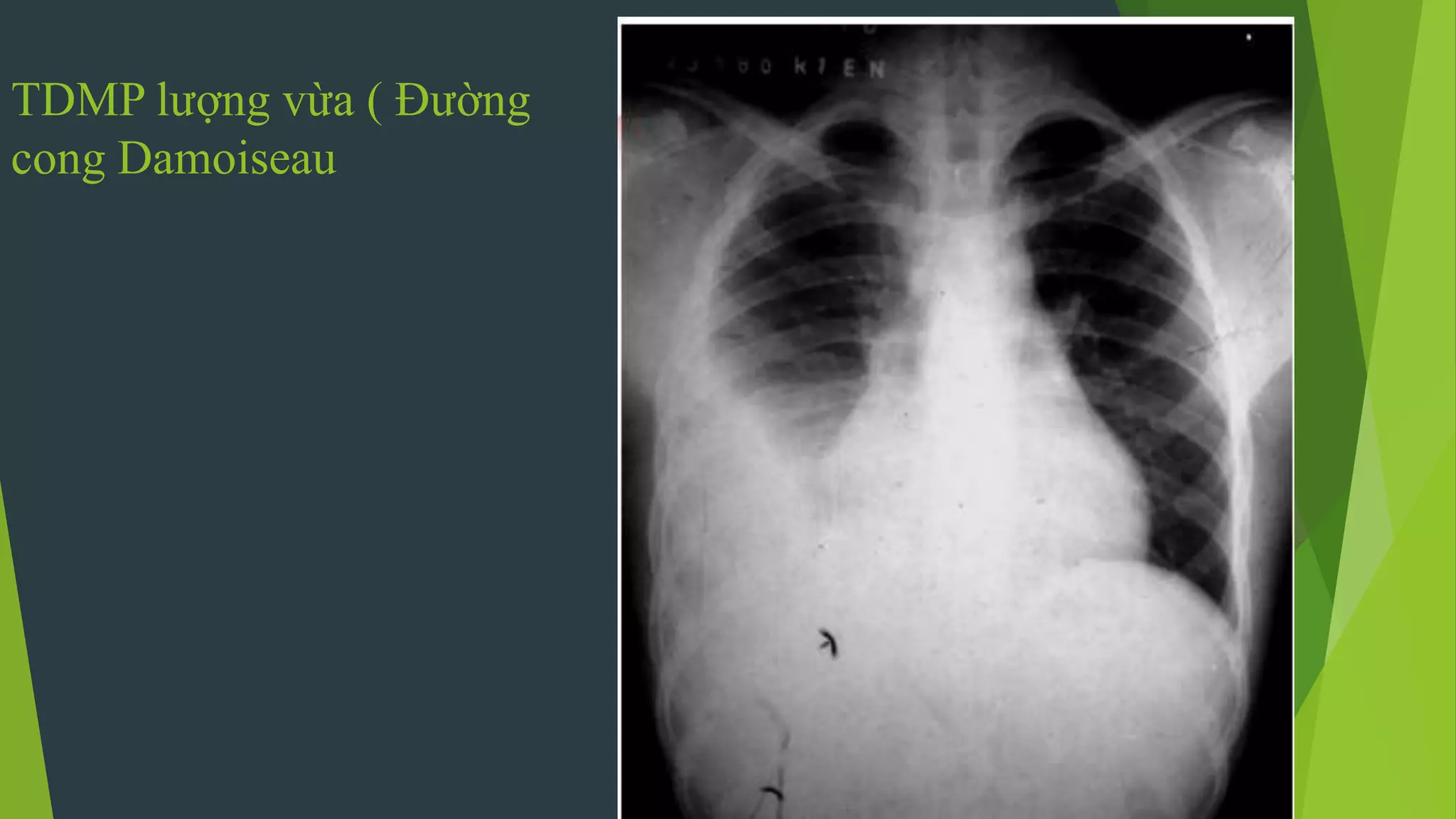 TDMP lượng vừa ( Đường
cong Damoiseau
 