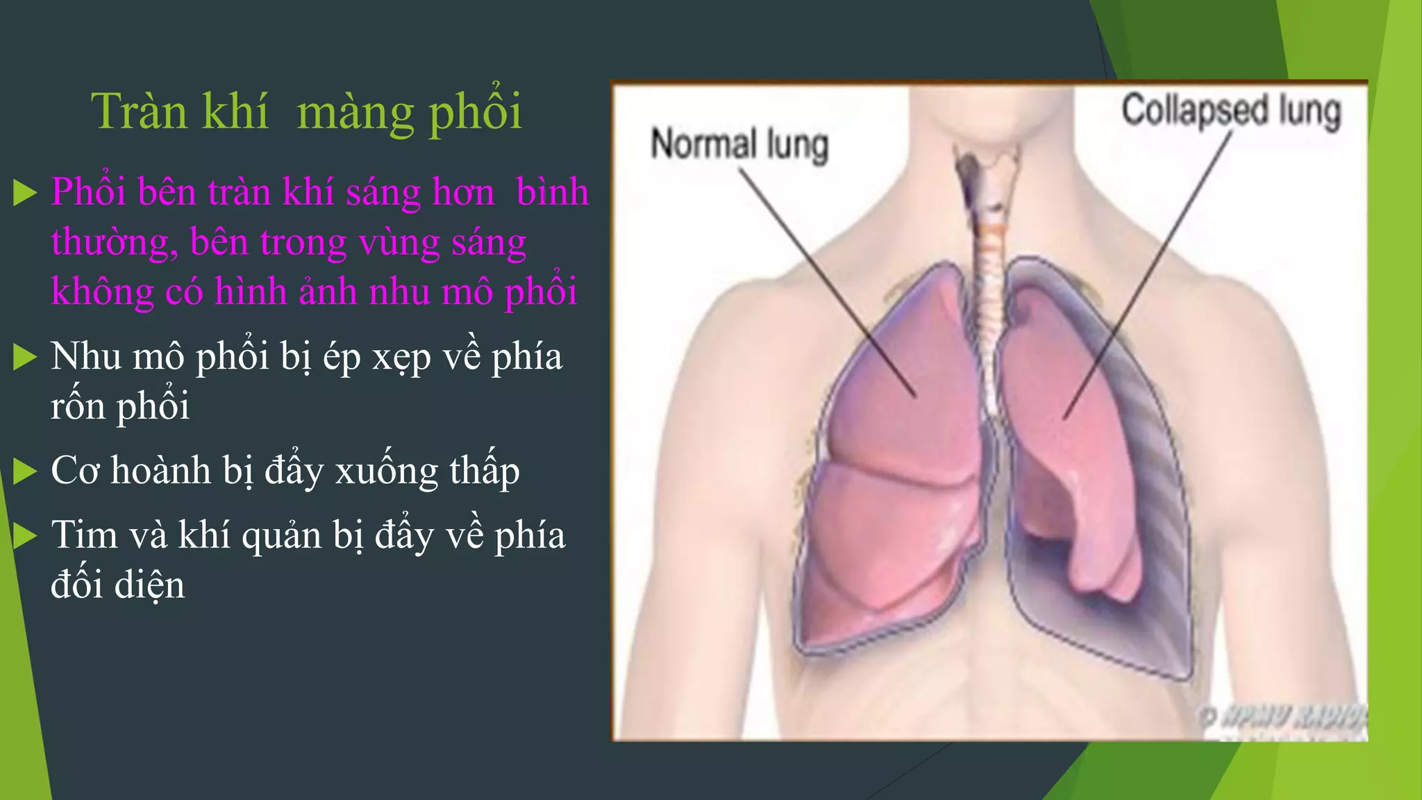 Tràn khí màng phổi
 Phổi bên tràn khí sáng hơn bình
thường, bên trong vùng sáng
không có hình ảnh nhu mô phổi
 Nhu mô phổi bị ép xẹp về phía
rốn phổi
 Cơ hoành bị đẩy xuống thấp
 Tim và khí quản bị đẩy về phía
đối diện
 