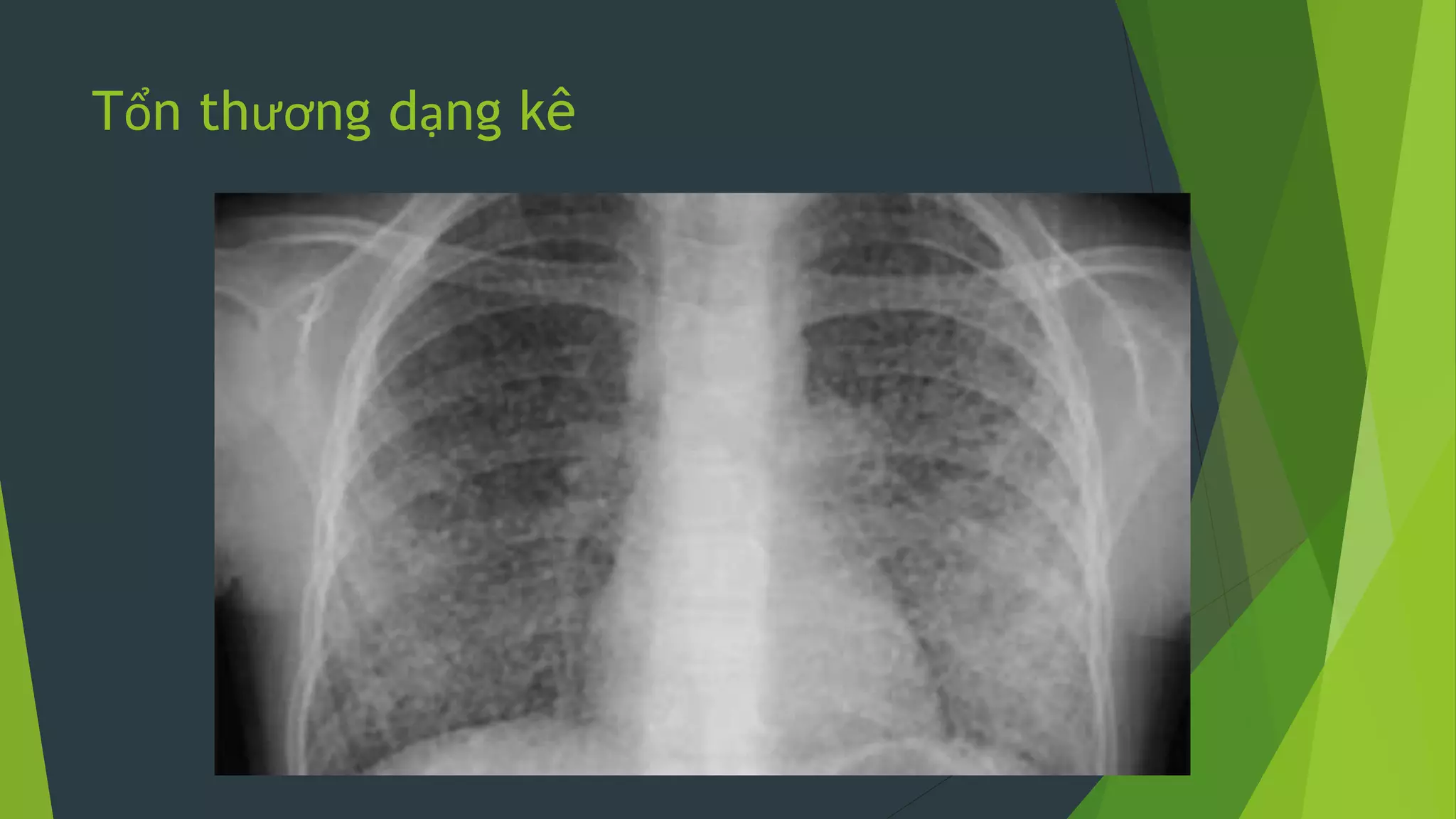 Tổn thương dạng kê
 