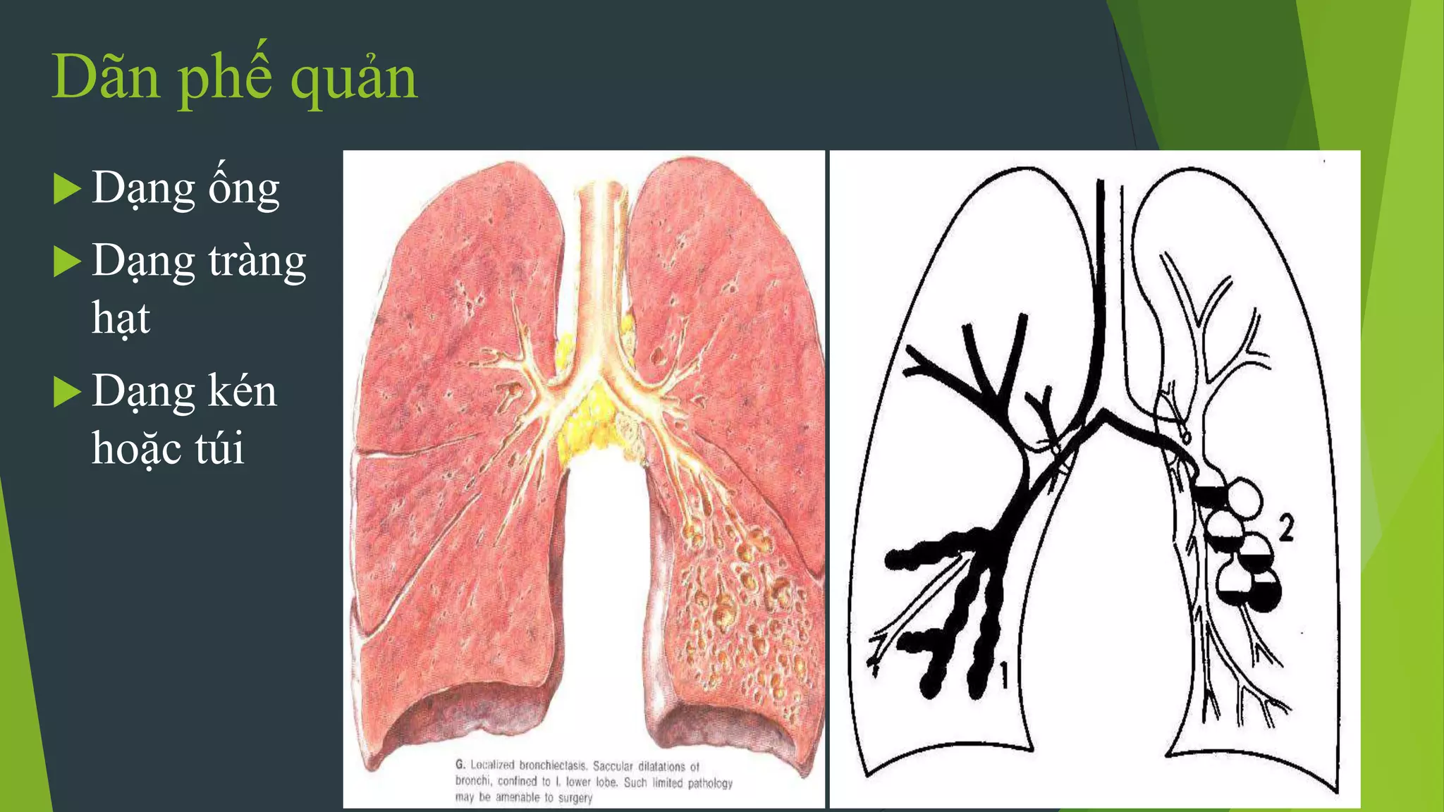 Dãn phế quản
 Dạng ống
 Dạng tràng
hạt
 Dạng kén
hoặc túi
 