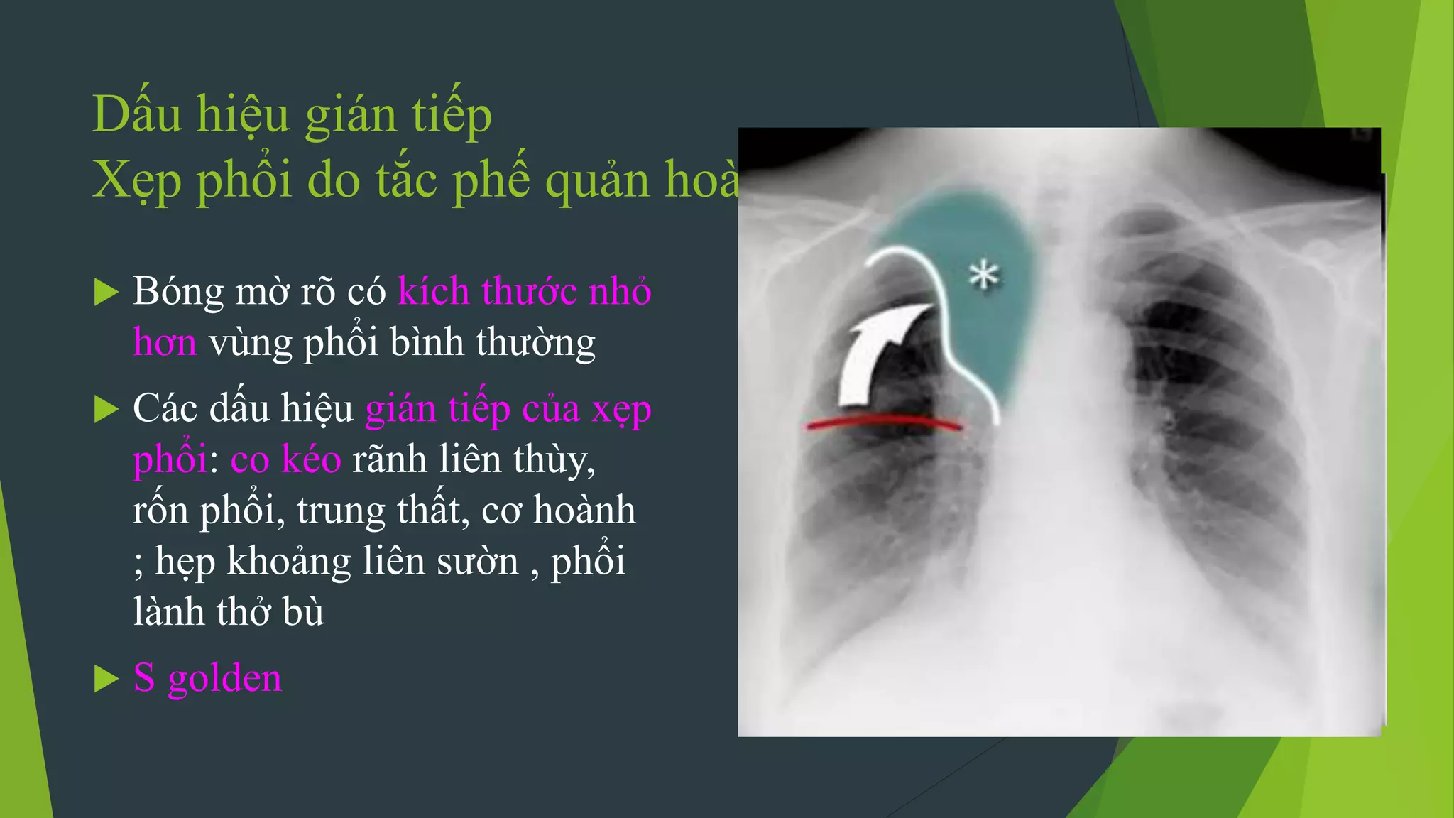 Dấu hiệu gián tiếp
Xẹp phổi do tắc phế quản hoàn toàn
 Bóng mờ rõ có kích thước nhỏ
hơn vùng phổi bình thường
 Các dấu hiệu gián tiếp của xẹp
phổi: co kéo rãnh liên thùy,
rốn phổi, trung thất, cơ hoành
; hẹp khoảng liên sườn , phổi
lành thở bù
 S golden
 