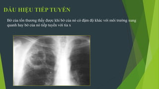 DẤU HIỆU TIẾP TUYẾN
Bờ của tổn thương thấy được khi bờ của nó có đậm độ khác với môi trường xung
quanh hay bờ của nó tiếp tuyến với tia x
 