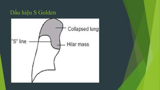 Dấu hiệu S Golden
 