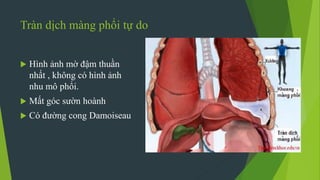 Tràn dịch màng phổi tự do
 Hình ảnh mờ đậm thuần
nhất , không có hình ảnh
nhu mô phổi.
 Mất góc sườn hoành
 Có đường cong Damoiseau
 