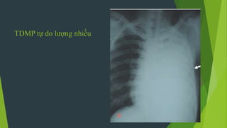 TDMP tự do lượng nhiều
 