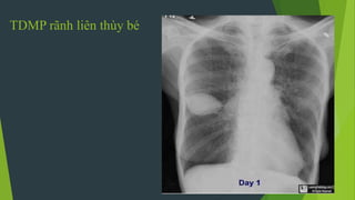 TDMP rãnh liên thùy bé
 