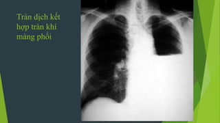 Tràn dịch kết
hợp tràn khí
màng phổi
 