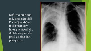 Khối mờ hình tam
giác thùy trên phổi
P, mờ đậm không
thuần nhất, đáy
hương về ngoại vi ,
đỉnh hướng về rốn
phổi, có hình ảnh
phế quản khí
 
