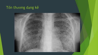 Tổn thương dạng kê
 