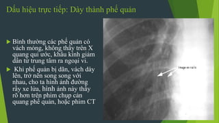 Dấu hiệu trực tiếp: Dày thành phế quản
 Bình thường các phế quản có
vách mỏng, không thấy trên X
quang qui ước, khẩu kính giảm
dần từ trung tâm ra ngoại vi.
 Khi phế quản bị dãn, vách dày
lên, trở nên song song với
nhau, cho ta hình ảnh đường
rầy xe lửa, hình ảnh này thấy
rõ hơn trên phim chụp cản
quang phế quản, hoặc phim CT
 