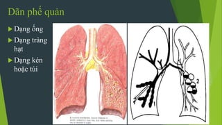 Dãn phế quản
 Dạng ống
 Dạng tràng
hạt
 Dạng kén
hoặc túi
 