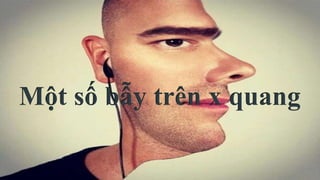 Một số bẫy trên x quang
 