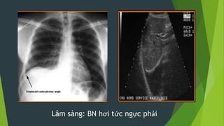 Lâm sàng: BN hơi tức ngực phải
 