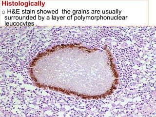 Histologically
o H&E stain showed the grains are usually
surrounded by a layer of polymorphonuclear
leucocytes .
oOutside the neutrophils zone there is granulation
tissue containing macrophages, lymphocytes,
plasma cells and few neutrophils. The
mononuclear cells increase in number towards the
periphery of the lesion. The outermost zone of the
lesion consists of fibrous tissue.
Fine needle aspiration:-
oMycetoma can be accurately diagnosed by
Fine Needle Aspiration (FNA) cytology and cell
block technique. Mycetoma lesions have a
distinct appearance in a cytology smear typical
to that seen in histopathological sections
 
