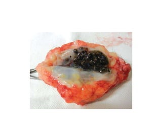 lesion after excision with black grains
inside
 