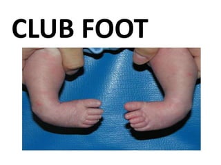 CLUB FOOT
 