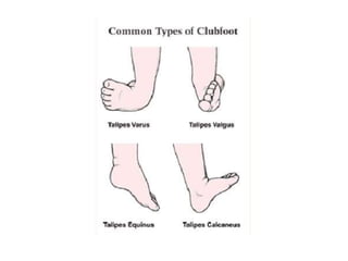 Clubb Foot