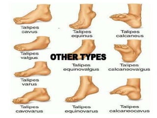 Clubb Foot