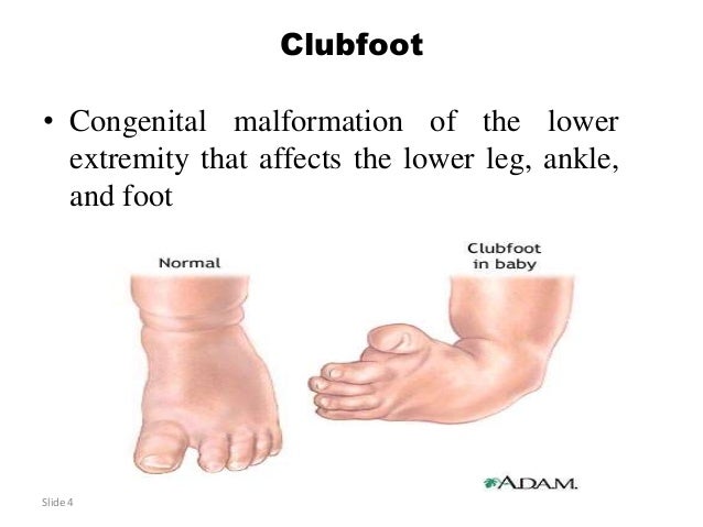 Clubb Foot Clubb Foot
