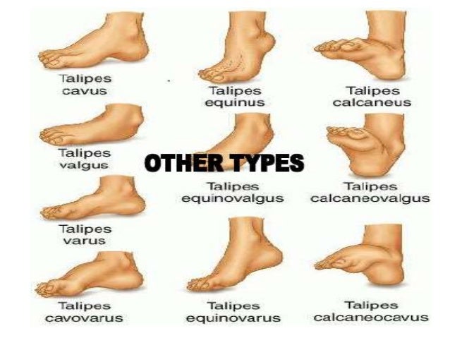 Clubb Foot Clubb Foot