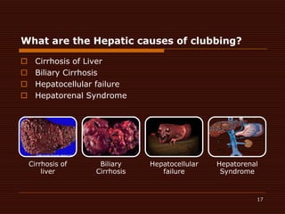 17What are the Hepatic causes of clubbing?Cirrhosis of LiverBiliary CirrhosisHepatocellular failureHepatorenal Syndrome