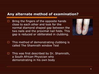 Any alternate method of examination?Bring the fingers of the opposite hands close to each other and look for the normal diamond shaped gap between the two nails and the proximal nail folds. This gap is reduced or obliterated in clubbing.This method of demonstrating clubbing is called The Shamroth window TestThis was first described by Dr. Shamroth, a South African Physician who  demonstrating in his own body  9